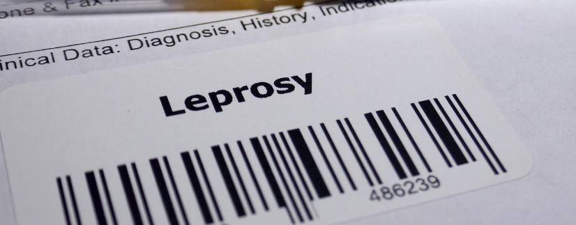 No Divorce on the Ground of Leprosy